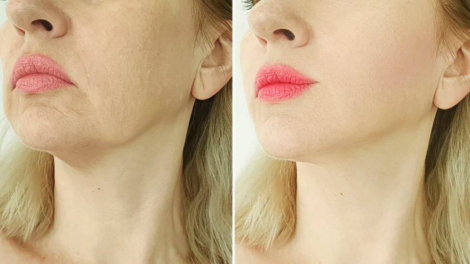 Come usare la vitamina C sul viso per ottenere un effetto botox